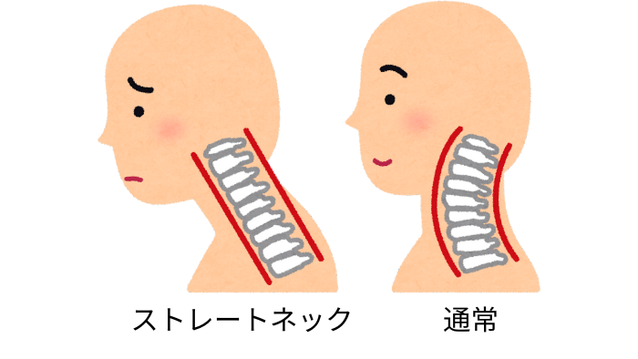 ストレートネック